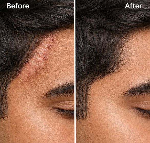 Scar Reduction Surgery